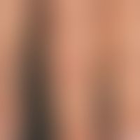 Porphyria cutanea tarda: detailed picture; the variety of skin lesions can be reduced to certain ...