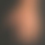 Porphyria cutana tarda. &nbsp;Flächige traumatisch induzierte Erosionen, flache Ulzerationen und&...