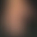Porphyria cutana tarda. &nbsp;Flächige traumatisch induzierte Erosionen, flache Ulzerationen und&...
