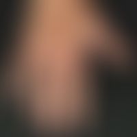 Porphyria cutana tarda. &nbsp;Flächige traumatisch induzierte Erosionen, flache Ulzerationen und&...