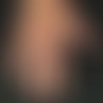 Onycholyse medikamentöse bzw. lichtinduzierte: bekannte Porphyrias cutanea tarda.&nbsp;Onycholyse...