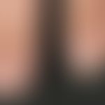 Nail: Slightly dry skin, cuticles slightly keratotic and not tightly focused, lateral nail wall a...