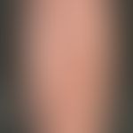 Porokeratosis superficialis disseminata actinica: Disseminated, reddened, marginalized papules up...