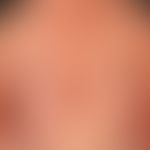 Porokeratosis superficialis disseminata actinica. 10 years of continuously increasing symptoms. m...