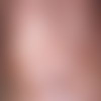 Porokeratosis superficialis disseminata actinica. Punktförmige, im Zentrum abgeflachte, an der Be...
