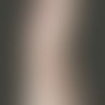 Porokeratosis superficialis disseminata actinica. 10 years ago first appeared, round, rough, litt...