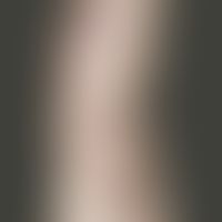 Porokeratosis superficialis disseminata actinica. Vor 10 Jahren erstmalig aufgetretene, runde, ra...