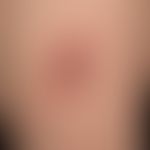 pseudolymphomas of the skin: since 6-8 moants of known, slowly growing, completely symptomless no...