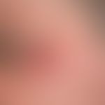 Slowly growing, completely asymptomatic skin alteration after an insect bite which the patient de...