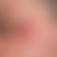 Pseudolymphome der Haut. Langsam wachsende, völlig symptomlose Hautveränderung nach einem von dem...