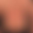 Psoriasis vulgaris. Generalisierte nicht vorbehandelte Psoriasis mit unterschiedlich großen schup...