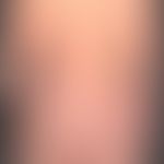Psoriasis vulgaris chronisch-stationäre (Plaque-Typ): sehr dichter, stellenweise großflächiger Be...