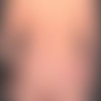 Psoriasis vulgaris chronisch-stationäre (Plaque-Typ): sehr dichter, stellenweise großflächiger Be...
