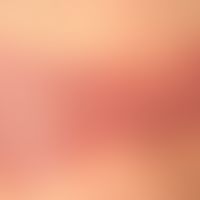 Psoriasis vulgaris chronisch-stationäre (Plaque-Typ): Detailafunahme
