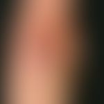 Psoriasis vulgaris chronisch-stationäre (Plaque-Typ): unbehandelte psoriatische Plaque am Ellenbo...