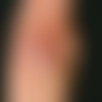 Psoriasis vulgaris chronisch-stationäre (Plaque-Typ): unbehandelte psoriatische Plaque am Ellenbo...