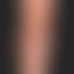 Psoriasis vulgaris chronisch-stationäre (Plaque-Typ): unbehandelte psoriatische Plaque am Ellenbo...