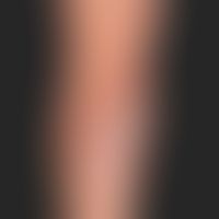 Psoriasis vulgaris chronisch-stationäre (Plaque-Typ): unbehandelte psoriatische Plaque am Ellenbo...