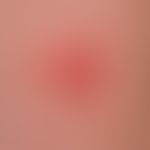 Psoriasis vulgaris chronisch-stationäre (Plaque-Typ): typische psoriatische Plaque mit mittelgrad...