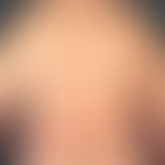 Psoriasis vulgaris chronisch-stationäre (Plaque-Typ): nahezu symmetrischer Befall an Rumpf und ob...