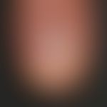 Psoriasis vulgaris chronisch-stationäre (Plaque-Typ): psoriatische Onychodystrophie mit Tüpfeln, ...