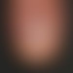 Psoriasis vulgaris chronisch-stationäre (Plaque-Typ): typische psoriatische Onychodystrophie mit ...