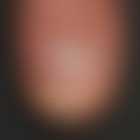 Psoriasis vulgaris chronisch-stationäre (Plaque-Typ): typische psoriatische Onychodystrophie mit ...