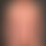 Psoriasis vulgaris chronisch-stationäre (Plaque-Typ): großflächige seit Jahren bekannte Psoriasis

