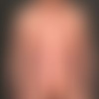 Psoriasis vulgaris chronisch-stationäre (Plaque-Typ): großflächige seit Jahren bekannte Psoriasis

