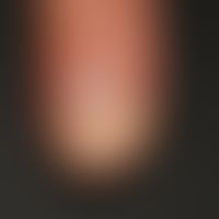 Psoriasis of the nails: Numerous spots and pronounced psoriatic onycholysis.
