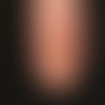 Psoriasis of the nails, crumbly destruction of the nail matrix (advanced onychodystrophy) with se...