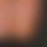 Psoriasis of the nails: combined psoriatic onychodystrophy with spotting, oil stain and onycholys...