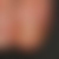 Psoriasis of the nails: combined psoriatic onychodystrophy with spotting, oil stain and onycholys...