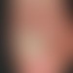 Psoriasis of the nails: circumscribed grey-yellowish crumbly onychodystrophy with subungual hyper...