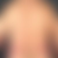 Chronic in-patient plaque psoriasis: chronic in-patient psoriasis; for months in a constant locat...