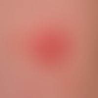 Psoriasis: mäßiggradig vorbehandelte psoriatische Plaque, scharf begrenzt, vergröbertes Oberfläch...