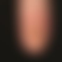Nail psoriasis: massive psoriatic onychodystrophy with complete crumbly destruction of the nail p...