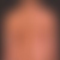 Psoriasis: Mosaikdermatose mit&nbsp;Expression psoriatischer Plaques in den Blaschko-Linien (re.S...