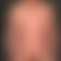 Psorisis, plaque type: chronic relapsing-remitting psoriasis with larger, in places confluent pla...