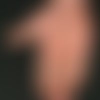 Psoriasis palmaris: seit Jahren bestehende, chronisch stationäre Plaque-Psoriasis der Hände mit l...