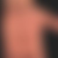 Psoriasis palmaris: pustular/dsyhidrotic form.
