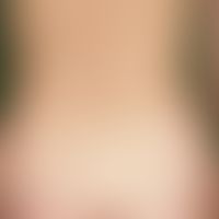 Psoriasis guttata: acutely and de novo appeared, 0.1-2.0 cm large, reddish, rough papules and pla...