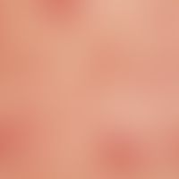 psoriasis guttata. small, exanthematic form of psoriasis after streptococcal infection. only slig...