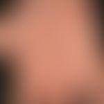 Psoriasis palmaris et plantaris (plaquet type): flat (rather discreet) reddening of the palm. cir...