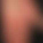 Psoriasis palmaris et plantaris (plaquet type): island-like, wart-like plaque covered with firmly...