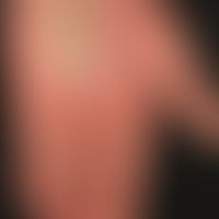 Psoriasis palmaris et plantaris (Plaquetyp): inselförmige, warzenartige&nbsp;mit festhaftenden Sc...