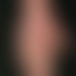 Psoriasis palmaris et plantaris (plaque-type): Patient with palmar plaque psoriasis, infestation ...