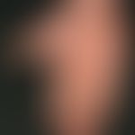 psoriasis palmaris et plantaris (plaquet type): palmo-plantar psoriasis known for years. no pre-t...