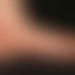 Psoriasis palmaris et plantaris (plaquet type): sharply defined, homogeneously red scaly and itch...