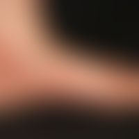 Psoriasis palmaris et plantaris (plaquet type): sharply defined, homogeneously red scaly and itch...